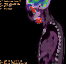 The patient shown in the PET/CT scan above has advanced head and neck cancer. The cancer is located primarily at the base of the skull (upper red area) and in the neck (lower red area)