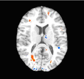 Colored areas show locations of brain injury, including injury to the frontal lobe, in a patient with mild traumatic brain injury