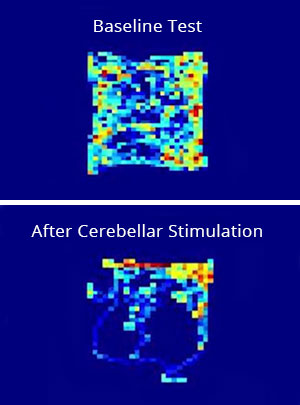 STIMULATING THE REWARD CENTER: These two heat maps show how much time a mouse spends exploring the four corners of a square enclosure (warmer colors =  greater number of visits). Top, baseline conditions in the absence of optogenetic stimulation: The mouse spends an equal amount of time exploring all four corners. Bottom, visits to the upper-right quadrant led to optogenetic stimulation of cerebellar axons in the VTA: under these conditions the mouse preferentially returns to the upper-right corner, presumably hoping for rewarding flashes of light.