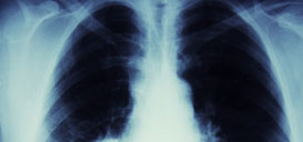 NIH Funds Investigation of Inhaled Lung Cancer Treatment