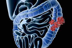Defeating Colorectal Cancer